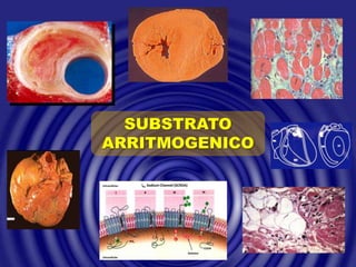 SUBSTRATO
ARRITMOGENICO
Extracellular INa Sodium Channel (SCN5A)
Intracellular
Deletion
COOH
NH2
N
S
K
P Q
H
R
Extracellular INa Sodium Channel (SCN5A)
Intracellular
Deletion
COOH
NH2
N
S
K
P Q
H
R
 