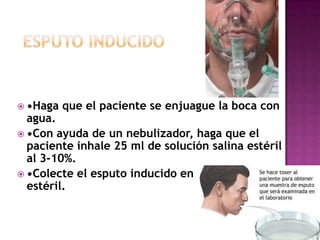  •Haga que el paciente se enjuague la boca con
agua.
 •Con ayuda de un nebulizador, haga que el
paciente inhale 25 ml de solución salina estéril
al 3-10%.
 •Colecte el esputo inducido en un envase
estéril.
 