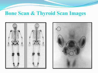 Bone Scan & Thyroid Scan Images
 