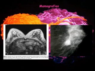 Mulher e Cancro da Mama