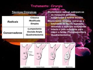 Mulher e Cancro da Mama