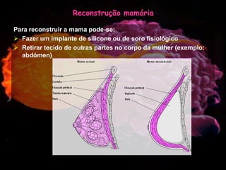 Mulher e Cancro da Mama