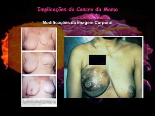 Mulher e Cancro da Mama