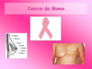 Mulher e Cancro da Mama