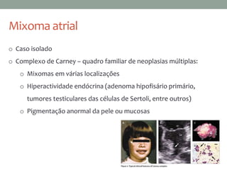Mixoma atrial
o Caso isolado
o Complexo de Carney – quadro familiar de neoplasias múltiplas:
o Mixomas em várias localizações
o Hiperactividade endócrina (adenoma hipofisário primário,
tumores testiculares das células de Sertoli, entre outros)
o Pigmentação anormal da pele ou mucosas
 
