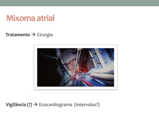 Mixoma atrial
Tratamento  Cirurgia
Vigilância (?)  Ecocardiograma (intervalos?)
 