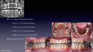 ©sylvainchamberland.com
•At 111 weeks, Strauman implant
✓ #14: 4,1 X 12 mm bone level
✓ #16: 4,8 X 12 mm bone level
✓ #24: 4,1 X 14 mm bone level
✓ #36: 4,8 X 8 mm tissu level WNI
•Debonding Jan 2012
HeAr061211 115 weeks
 
