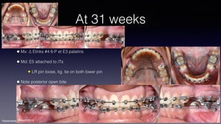 ©sylvainchamberland.com
At 31 weeks
• Mx: ∆ Elinks #4 6-P et E3 palatins
• Md: E5 attached to /7s
✦ LR pin loose, lig. tie on both lower pin
• Note posterior open bite
LiNda190814
LiNda290914
 