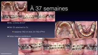 ©sylvainchamberland.com
LiNda290914
À 37 semaines
• Mx: ∆ Elinks #4 6-P
• Md: E5 attached to /7s
✦ resserrer TAD inf droit, E4 TAD-2e
PmI
• Notez béance postérieure
LiNda121114
 