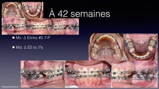 ©sylvainchamberland.com
À 42 semaines
• Mx: ∆ Elinks #5 7-P
• Md: ∆ E5 to /7s
LiNda121114
LiNda171214
 