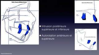 ©sylvainchamberland.com
•Intrusion postérieure
supérieure et inférieure
•Autorotation antérieure et
supérieure
 