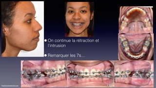 ©sylvainchamberland.com
•On continue la rétraction et
l’intrusion
•Remarquer les 7s…
LaMaNda260115
 