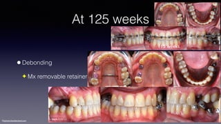 ©sylvainchamberland.com
At 125 weeks
•Debonding
✦ Mx removable retainer
HeAr061211 115 weeks
HeAr210112
 