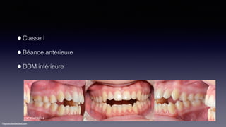 ©sylvainchamberland.com
•Classe I
•Béance antérieure
•DDM inférieure
ChOlGa220514
 