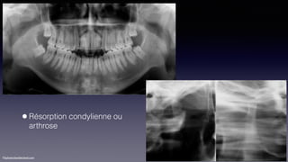 ©sylvainchamberland.com
•Résorption condylienne ou  
arthrose
 