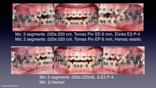 ©sylvainchamberland.com
ChOlGa030914
Mx: 3 segments .020x.020 cnt. Tomas Pin SD 6 mm, Elinks E3 P-4 
Md: 2 segments .020x.020 cnt. Tomas Pin EP 6 mm, Hamac elastic
ChOlGa221014
Mx: 3 segments .020x.025niti. ∆ E3 P-4.
Md: ∆ Hamac
7 weeks later
 