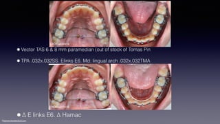 ©sylvainchamberland.com
•Vector TAS 6 & 8 mm paramedian (out of stock of Tomas Pin
•TPA .032x.032SS. Elinks E6. Md: lingual arch .032x.032TMA
ChOlGa030914
ChOlGa221014
•∆ E links E6. ∆ Hamac
 
