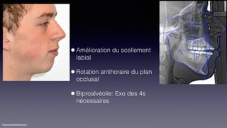 ©sylvainchamberland.com
•Amélioration du scellement
labial
•Rotation antihoraire du plan
occlusal
•Biproalvéolie: Exo des 4s
nécessaires
 