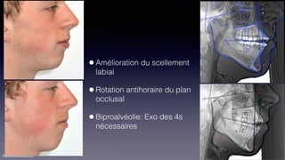 ©sylvainchamberland.com
•Amélioration du scellement
labial
•Rotation antihoraire du plan
occlusal
•Biproalvéolie: Exo des 4s
nécessaires
 