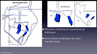 ©sylvainchamberland.com
•Intrusion postérieure supérieure et
inférieure
•Autorotation antérieure du plan
mandibulaire
 