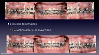 ©sylvainchamberland.com
•Évolution 18 semaines
✦ Rétraction antérieure maximisée
AmCo12-08-14AmCo29-10-14
AmCo10-12-14
 