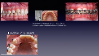 ©sylvainchamberland.com
•Tomas Pin SD 8 mm
CIARLANTINI R., MELSEN B., Miniscrew-Retained Pontics
in Growing Patients:A Biological Approach, JCO october 2012
 