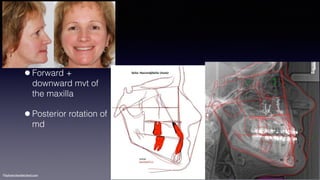 ©sylvainchamberland.com
•Forward +
downward mvt of
the maxilla
•Posterior rotation of
md
 