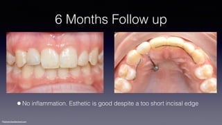 ©sylvainchamberland.com
6 Months Follow up
•No inﬂammation. Esthetic is good despite a too short incisal edge
 