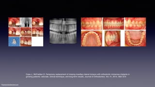 ©sylvainchamberland.com
Cope J., McFadden D.,Temporary replacement of missing maxillary lateral incisors with orthodontic miniscrew implants in
growing patients: rationale, clinical technique, and long-term results, Journal of Orthodontics, Vol. 41, 2014, S62–S74
 