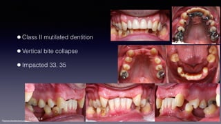 ©sylvainchamberland.com
•Class II mutilated dentition
•Vertical bite collapse
•Impacted 33, 35
SeCa2111-8
 