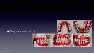 ©sylvainchamberland.com
•Diagnostic wax set up
 