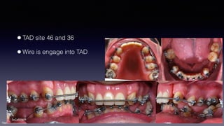 ©sylvainchamberland.com
•TAD site 46 and 36
•Wire is engage into TAD
SeCa020609
 