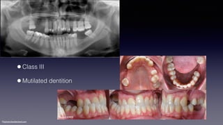 ©sylvainchamberland.com
•Class III
•Mutilated dentition
HeAr030909
 