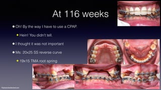 ©sylvainchamberland.com
At 116 weeks
•Oh! By the way I have to use a CPAP.
✦ Hein! You didn’t tell.
•I thought it was not important
•Ms: 20x25 SS reverse curve
✦ 19x15 TMA root spring
SeCa260411
 