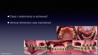 ©sylvainchamberland.com
•Class I relationship is achieved!
•Vertical dimension was maintained
SeCa140812
 