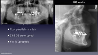 ©sylvainchamberland.com
•Prior to surgery
•Root parallelism is fair
•33 & 35 are erupted
•#47 is uprighted
SeCa1003
SeCa140812
183 weeks
 