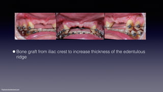 ©sylvainchamberland.com
•Bone graft from iliac crest to increase thickness of the edentulous
ridge
SeCa141112
 