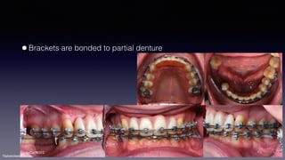 ©sylvainchamberland.com
•Brackets are bonded to partial denture
SeCa190312
 