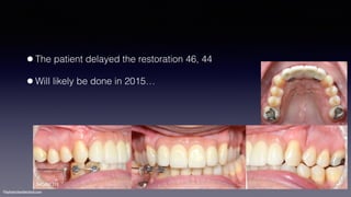 ©sylvainchamberland.com
•The patient delayed the restoration 46, 44
•Will likely be done in 2015…
SeCa041213
 