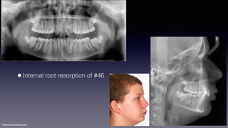 ©sylvainchamberland.com
•Internal root resorption of #46
 