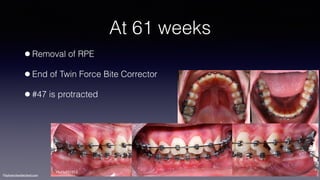 ©sylvainchamberland.com
At 61 weeks
•Removal of RPE
•End of Twin Force Bite Corrector
•#47 is protracted
MaHe031012
 