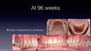 ©sylvainchamberland.com
At 96 weeks
•Class I relationship is achieved
MaHe040613
 