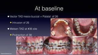 ©sylvainchamberland.com
At baseline
•Vector TAS mesio buccal + Palatal of 26
✦ Intrusion of 26
•Melsen TAD at #36 site
✦ Protraction of 38
HeAr280909
 