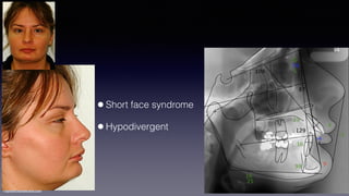 ©sylvainchamberland.com
•Short face syndrome
•Hypodivergent
 
