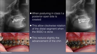 ©sylvainchamberland.com
•When posturing in class I a
posterior open bite is
created
•This allow clockwise rotation
of the distal segment when
the BSSO is done
•This reduce slightly the
advancement of the chin
 