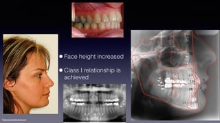 ©sylvainchamberland.com
•Face height increased
•Class I relationship is
achieved
NaPa310507
 