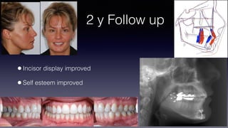 ©sylvainchamberland.com
2 y Follow up
•Incisor display improved
•Self esteem improved
NaPa030909
 