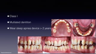 ©sylvainchamberland.com
•Class I
•Mutilated dentition
•Wear sleep apnea device > 2 years
ClPe140512
 