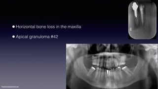 ©sylvainchamberland.com
•Horizontal bone loss in the maxilla
•Apical granuloma #42
 