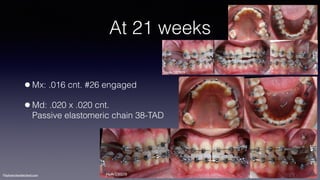©sylvainchamberland.com
At 21 weeks
•Mx: .016 cnt. #26 engaged
•Md: .020 x .020 cnt.  
Passive elastomeric chain 38-TAD
HeAr280909
HeAr230210
 